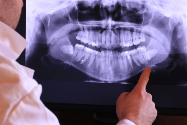 Best Emergency Wisdom Teeth Removal in Covington, VA